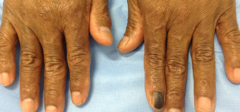 Skin Cancer Is Trickier Than You Think